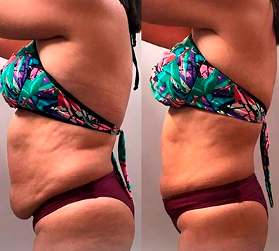 Before and after transformation 2 - Emagrecentro Orlando