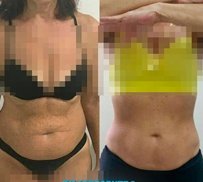 Before and after transformation 4 - Emagrecentro Orlando