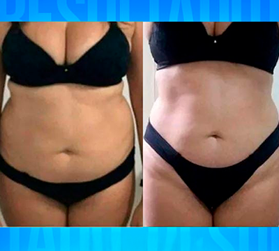 Before and after transformation 6 - Emagrecentro Orlando
