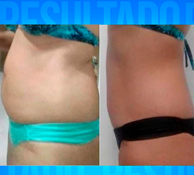 Before and after transformation 7 - Emagrecentro Orlando