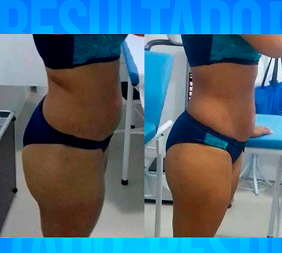 Before and after transformation 8 - Emagrecentro Orlando