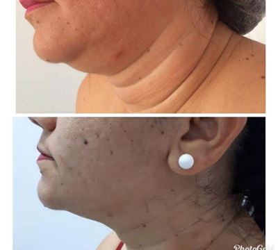Before and after transformation 9 - Emagrecentro Orlando