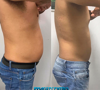 Before and after transformation 10 - Emagrecentro Orlando