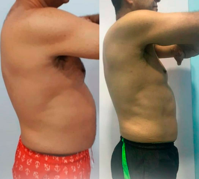 Before and after transformation 15 - Emagrecentro Orlando