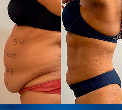 Before and after transformation 17 - Emagrecentro Orlando