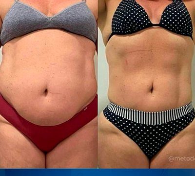 Before and after transformation 18 - Emagrecentro Orlando
