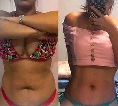 Before and after transformation 19 - Emagrecentro Orlando