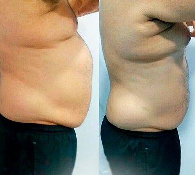 Before and after transformation 23 - Emagrecentro Orlando
